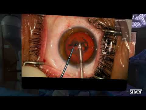 Apple Vision Pro for Complete Cataract Surgery