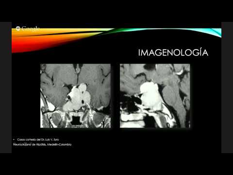 Se il miele per il cancro alla prostata Irradiazione adenoma prostatico
