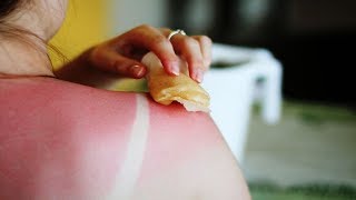 How to Get Rid of Sunburn Redness Overnight | 5 Home Remedies for Sunburn on Face.
