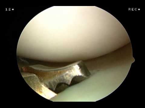 Cirugía de desgarro de menisco lateral