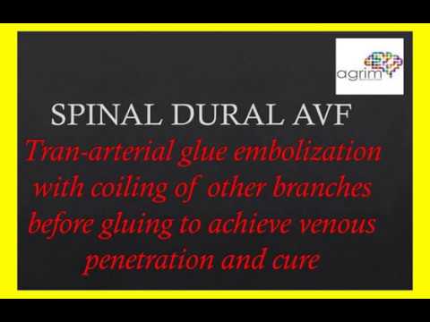 Spinal Dural AVF embolization