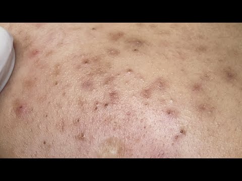 Blackhead Removal: The Ultimate Guide to Clear Skin!