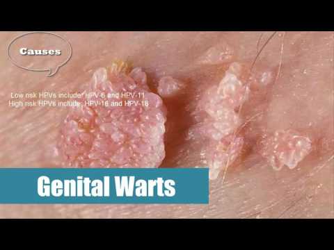 hpv genitális hólyagok