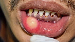 Should This Cyst Be Popped? How To Remove An Oral Mucocele