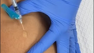 How To Give an Intradermal Injection | PPD | TB Test | Medical Assisting