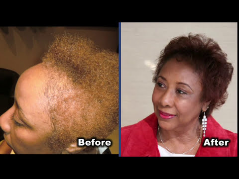 Laser Therapy Corrects Hair Loss In African American...