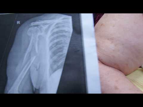 Shoulder Apprehension Test and Relocation Test