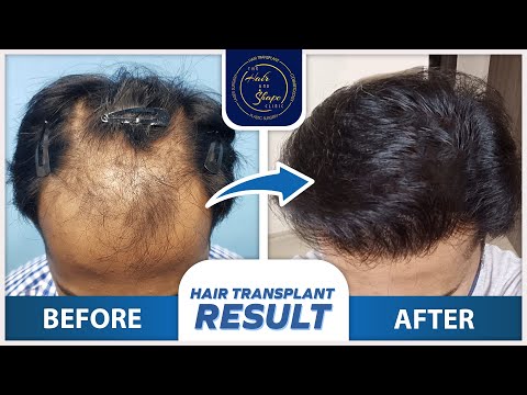 Hair Transplant Result | Before & After | By Dr.Pranil More | Best Hair Transplant Clinic In Mumbai