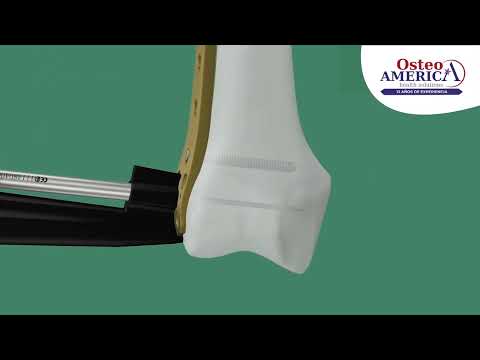 Técnica Quirúrgica Placas para fracturas distales de Fémur