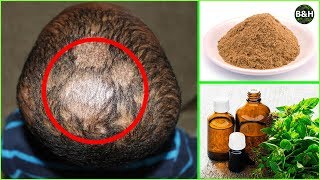 Ringworm Hair Loss Treatment | How To Get Rid of Scalp Fungus Instantly (Tinea Capitis)