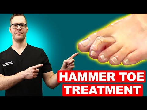 , title : 'Hammer Toe Exercises, Stretches & Treatment [Claw Toes & Mallet Toes!]'
