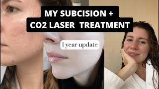 1 Year later | Subcision and ablative CO2 Laser Results