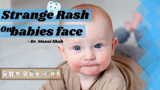 Rash-Teething Rash | Red Patch or dots on face of baby around 6months of age .