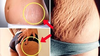 HOW TO GET RID OF CELLULITE / STRETCH MARKS ON YOUR LEGS,STOMACH AND BUTT.