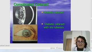 Cataract
