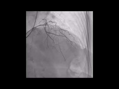 Chronic Total Occlusion Recanalization by Radial Artery Access