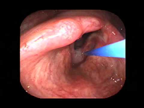 Hpv oropharyngeal cancer diagnosis