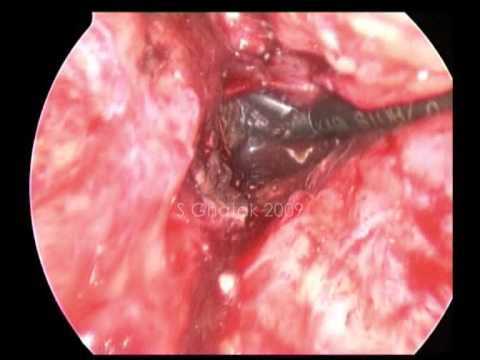 Laparoscopic necrosectomy