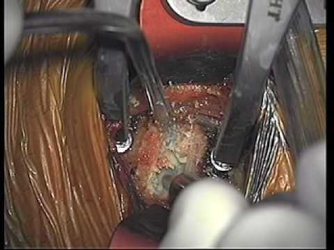 Dr. Ali Bydonは、ACDFの手順を実行します。 (Dr. Ali Bydon Performs An ACDF Procedure)