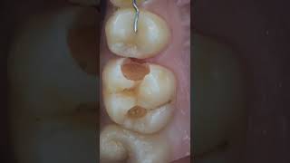 Major decay, pulp capping, and a love for composite fillings! 💉🦷 #Dentistry #DentalCare #SmileBright