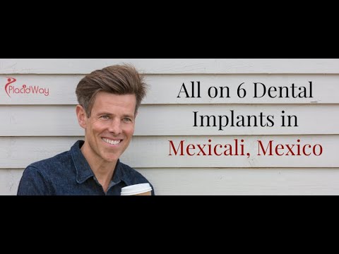 All on 6 Dental Implants in Mexicali, Mexico