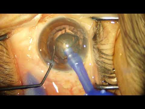 image-What causes deep eyes?