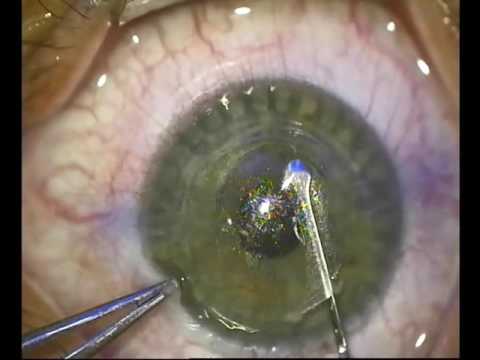 Metoda bates tratament ocular
