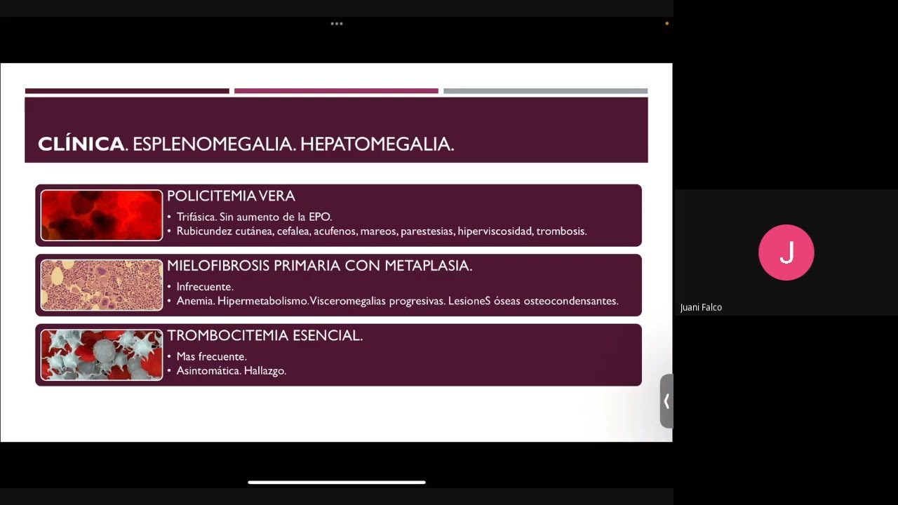 Clase Clínica Médica - Leucemia, Linfoma y Síndrome de Lisis Tumoral - Prof Belén Montenegro
