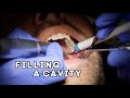 How Does A Dentist Fill A Cavity?