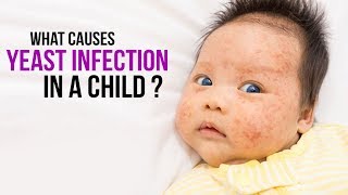 What causes yeast infection in a child? | SKIN INFECTIONS | FUNGAL INFECTIONS