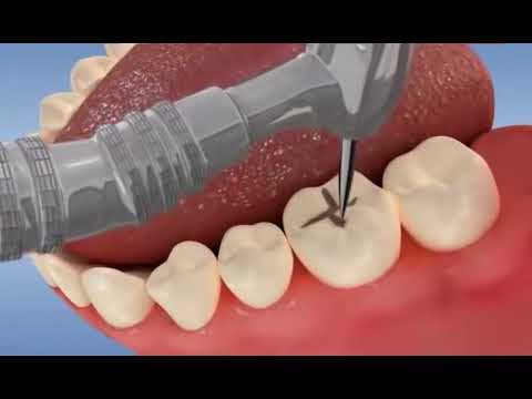 Soigner les sillons dentaires infiltrés de carie