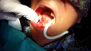 Implant Infection Removal #7