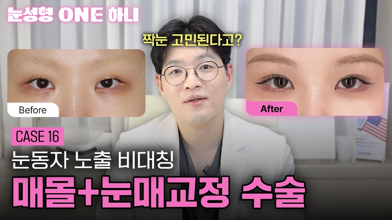 눈동자 노출이 비대칭이라고?🤔 | 눈성형 ONE 하니 쇼츠 영상 미리보기