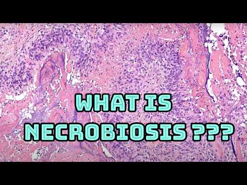 What is necrobiosis??? Palisaded necrobiotic granuloma pattern explained (pathology histology)