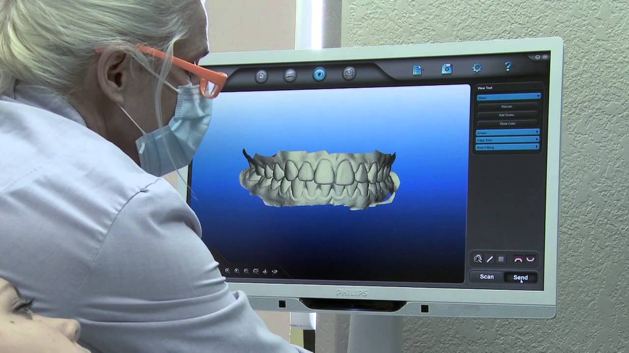 iTero® Orthodontic Scan Demo 2013