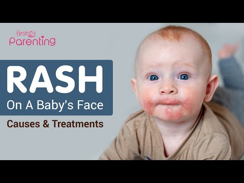 Rash On Baby's Face -  Reasons and Remedies