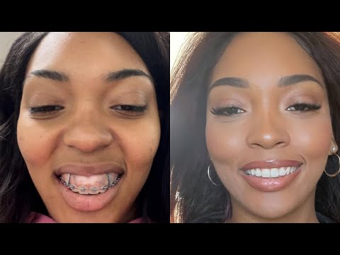 Gummy Smile, Braces Journey, TADS, Gingivectomy