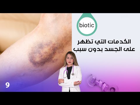 فيديو | الكدمات التي تظهر على الجسد بدون سبب، متلازمة القلب المكسور - م٤ Biotic - الحلقة ٩