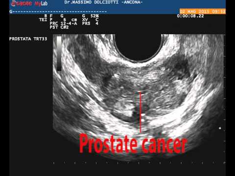 Eziologia della iperplasia prostatica Adenoma prostatico Krasnodar