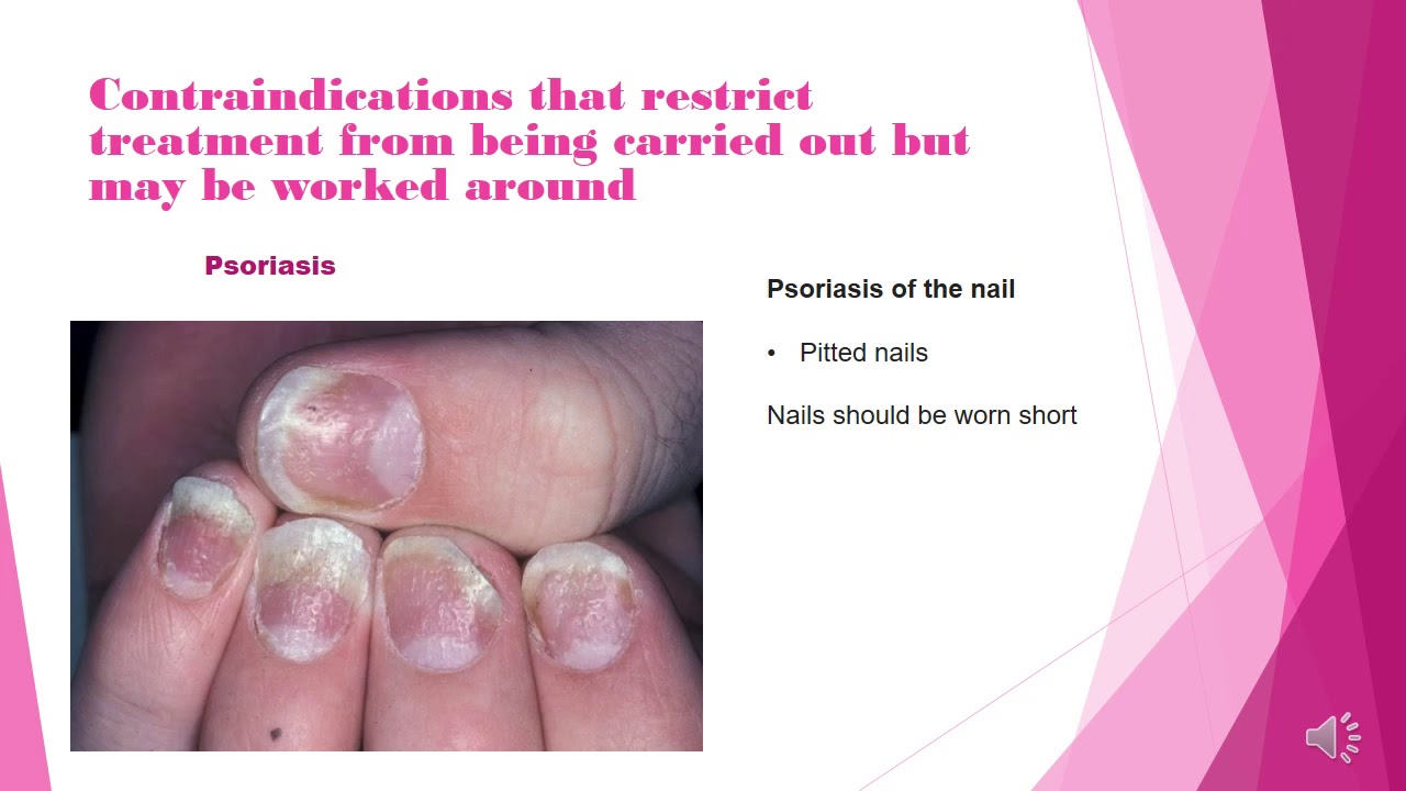 Watch video Common Contraindications and Contra-actions for nail treatments Now Common Contraindications and Contra-actions for nail treatments