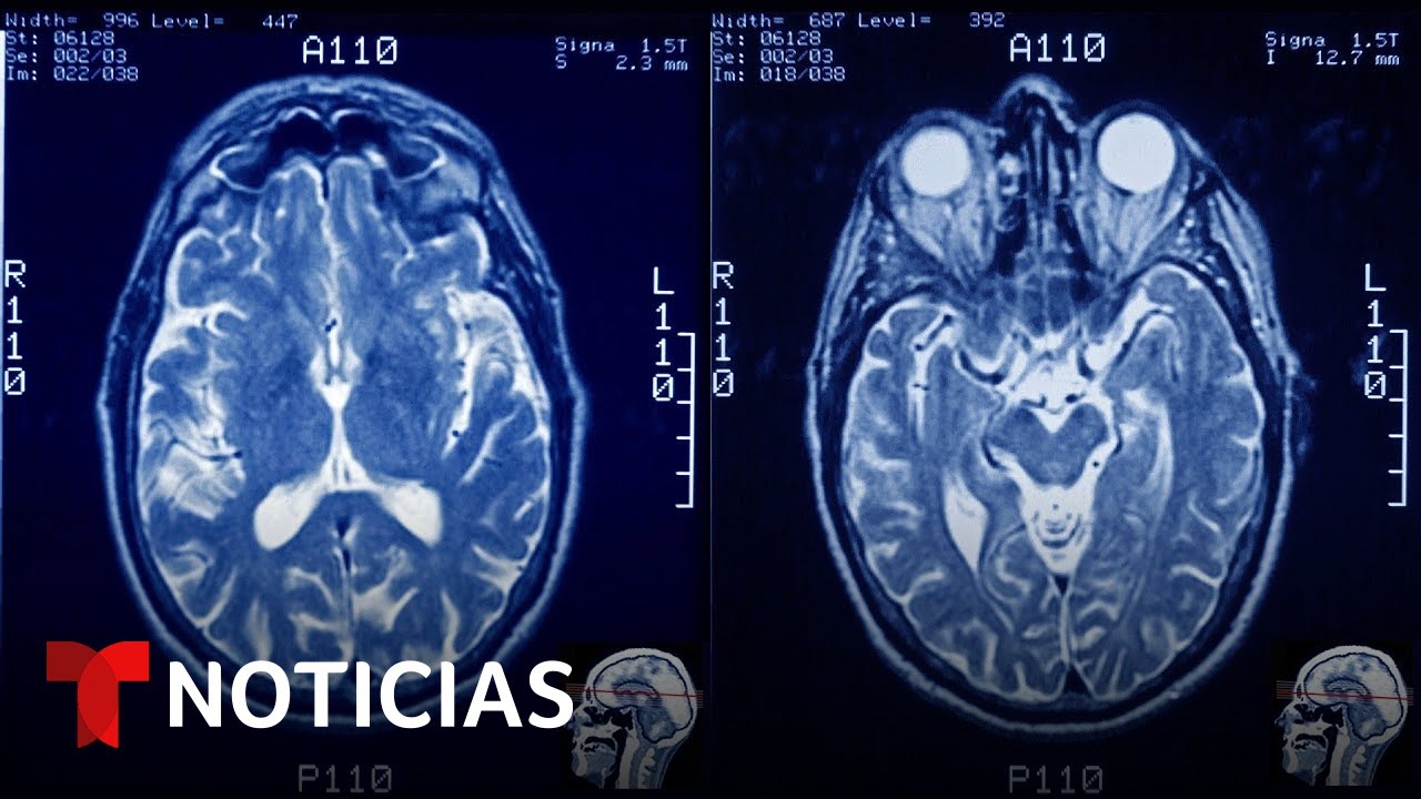 Expertos nos advierten qué hacer para evitar el riesgo de demencia