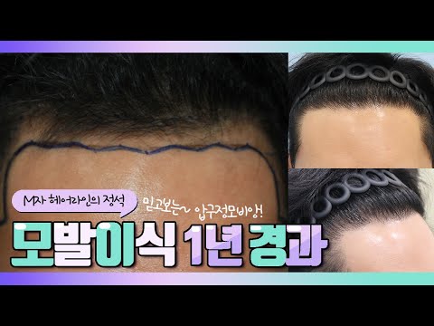20대후반 남성,비절개 3300모, M자 모발이식 1년 경과영상!