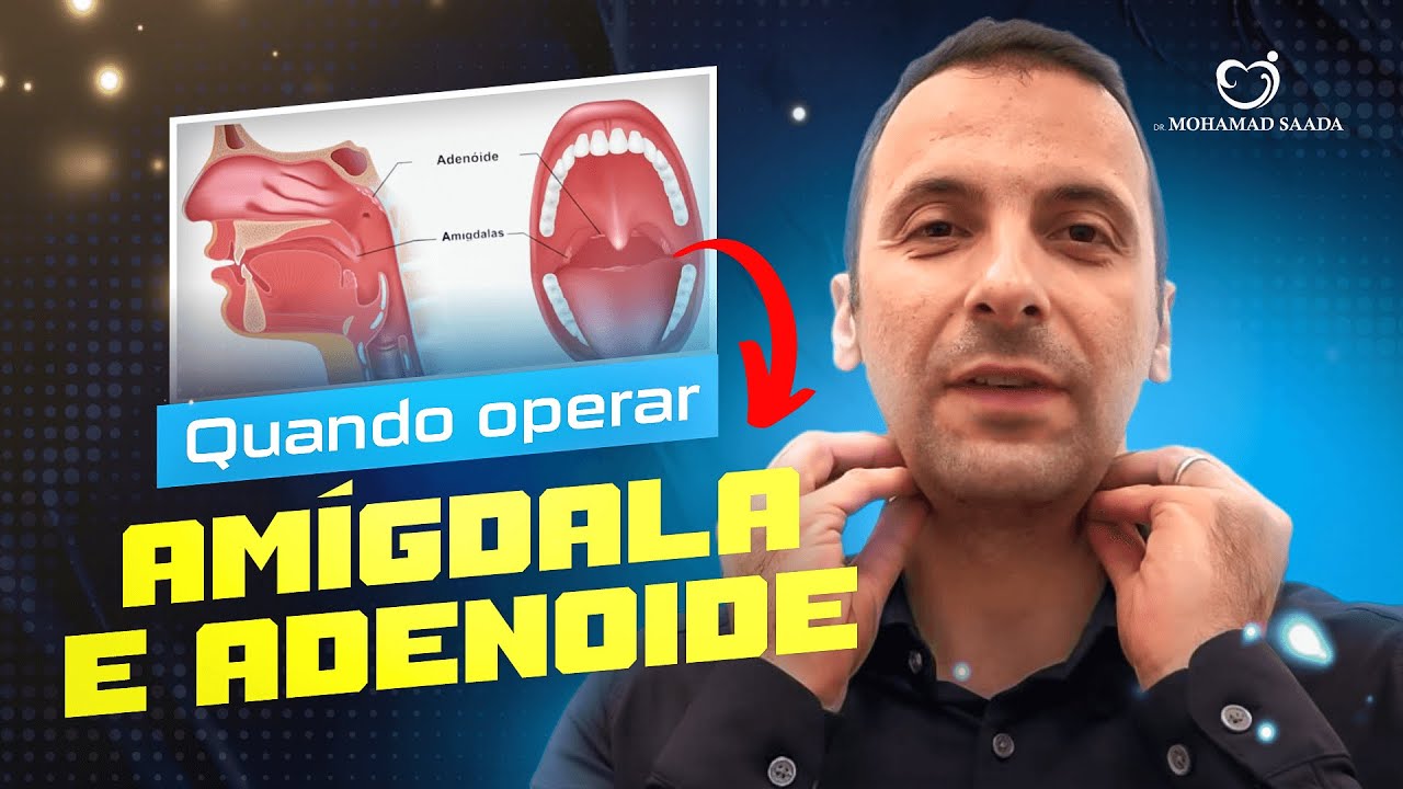 QUAIS OS BENEFÍCIOS DE OPERAR A A AMÍGDALA E ADENOIDE
