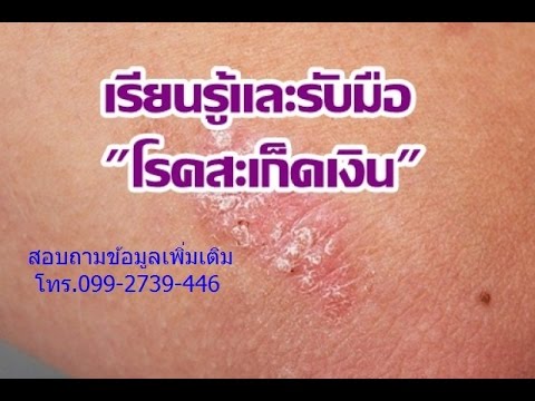 แชมพูสำหรับโรคสะเก็ดเงิน โรคสะเก็ดเงินรีสอร์ทฟาร์อีสท์