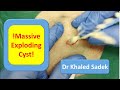 Massive 20 Year Cyst Explosion LipomaCyst Com Dr Khaled Sadek