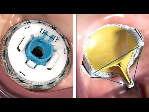 Best Mitral Valve Replacement Surgery Hospitals in India
