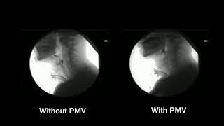 Product video: Passy Muir Tracheostomy, Ventilator Swallowing & Speaking Valves