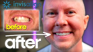 Invisalign REVIEW – What They DON’T Tell You About Straightening Teeth!