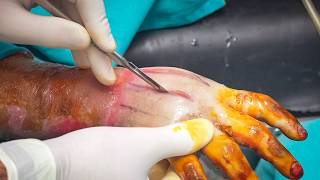 Escharotomy - Burn Care Series