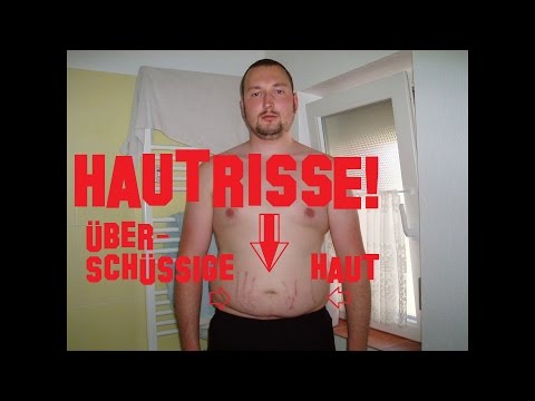 Mikostop für die Behandlung der Nägel Gribok von den Großmutterbeinen